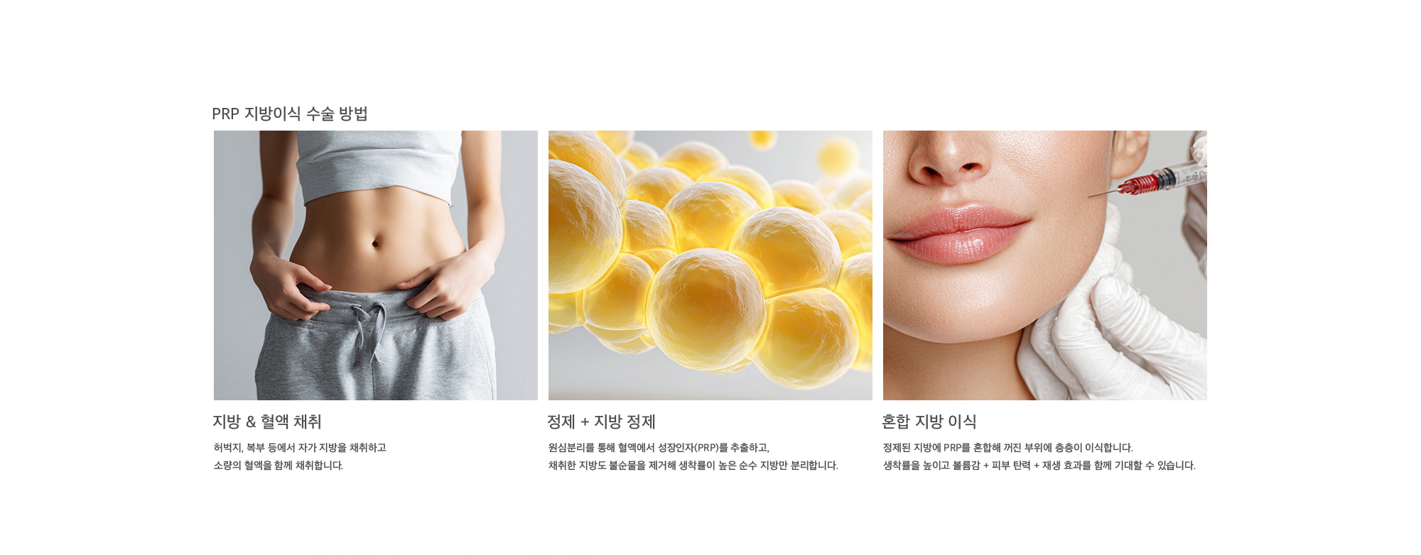 PRP 지방이식 수술 방법 지방 & 혈액 채취 : 허벅지, 복부 등에서 자가 지방을 채취하고 소량의 혈액을 함께 채취합니다. 정제 + 지방 정제 : 원심분리를 통해 혈액에서 성장인자(PRP)를 추출하고, 채취한 지방도 불순물을 제거해 생착률이 높은 순수 지방만 분리합니다. 혼합 지방 이식 : 정제된 지방에 PRP를 혼합해 꺼진 부위에 층층이 이식합니다. 생착률을 높이고 볼륨감 + 피부 탄력 + 재생 효과를 함께 기대할 수 있습니다.
