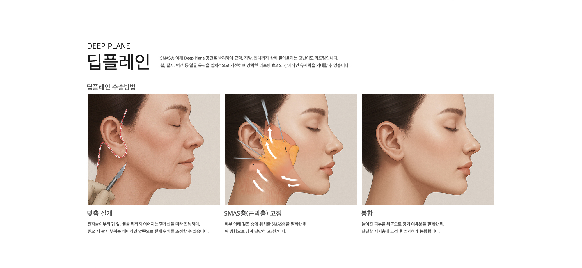 딥플레인 SMAS층 아래 Deep Plane 공간을 박리하여 근막, 지방, 인대까지 함께 들어올리는 고난이도 리프팅입니다. 볼, 팔자, 턱선 등 얼굴 윤곽을 입체적으로 개선하며 강력한 리프팅 효과와 장기적인 유지력을 기대할 수 있습니다.