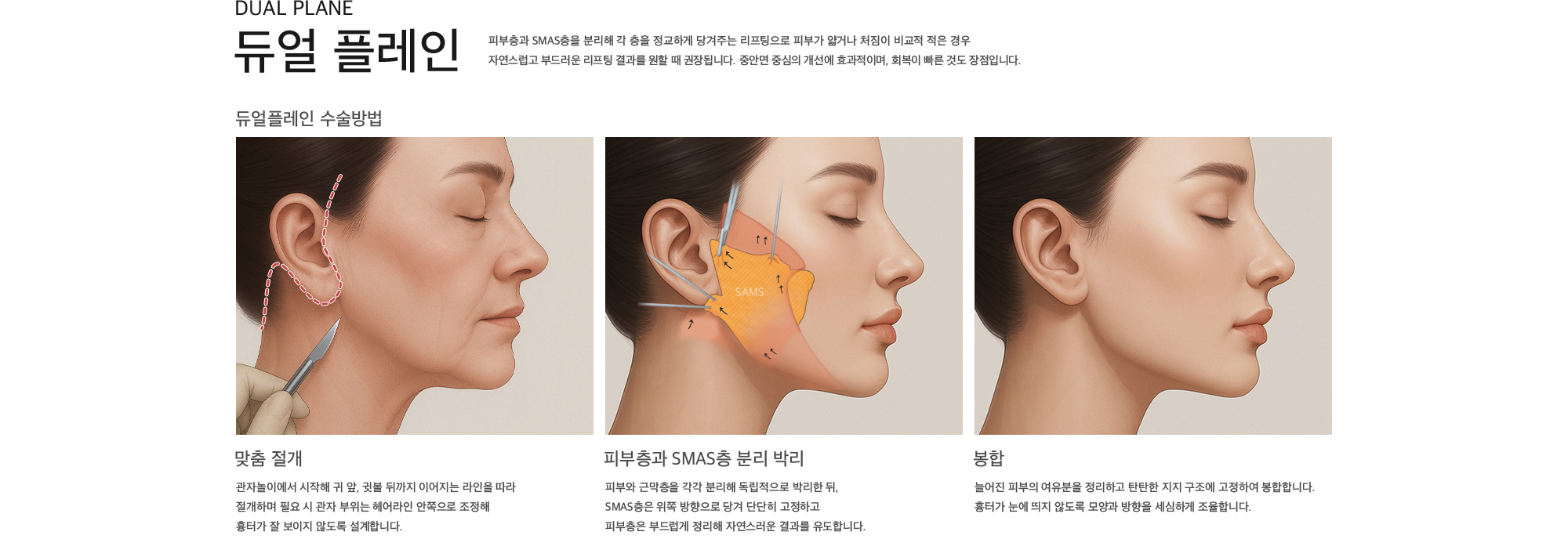 듀얼 플레인 피부층과 SMAS층을 분리해 각 층을 정교하게 당겨주는 리프팅으로 피부가 얇거나 처짐이 비교적 적은 경우 자연스럽고 부드러운 리프팅 결과를 원할 때 권장됩니다. 중안면 중심의 개선에 효과적이며, 회복이 빠른 것도 장점입니다.