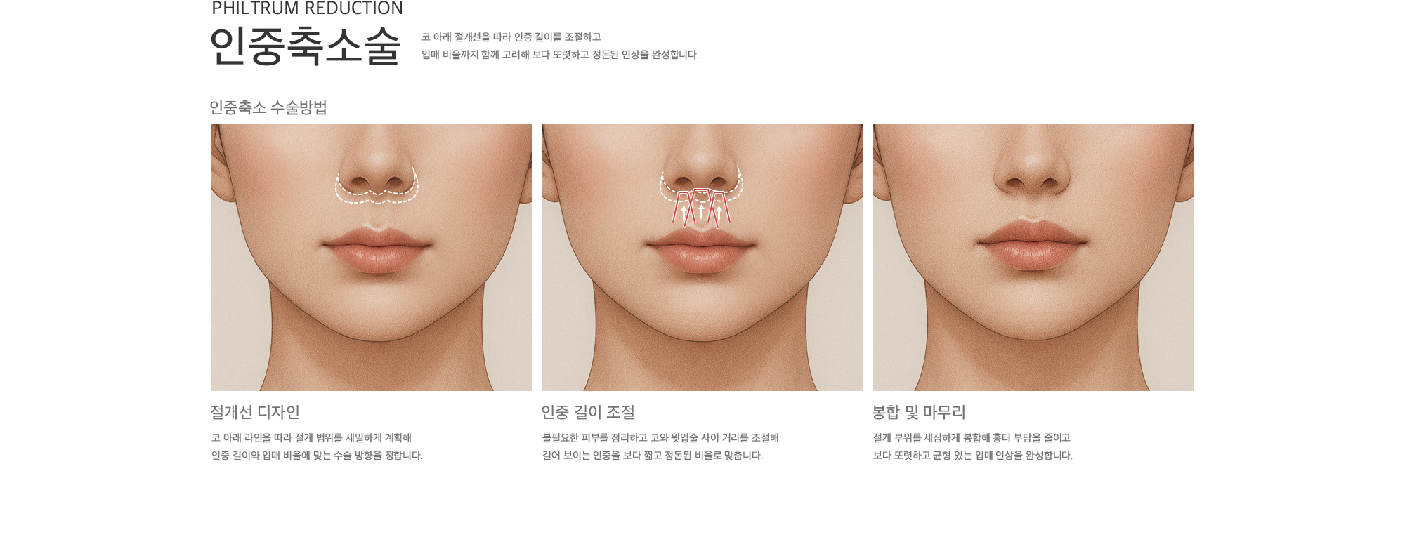 입꼬리 방향과 근육을 조절해 자연스럽게 올라간 밝은 인상으로 개선합니다. 절개선 디자인 | 인중 길이 조절 | 봉합 및 마무리
