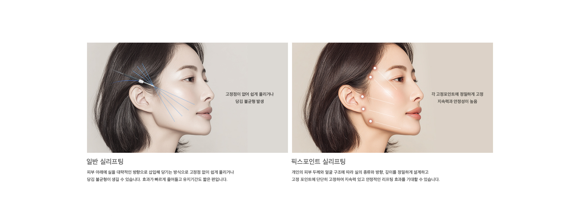 
        일반 실리프팅 : 피부 아래에 실을 대략적인 방향으로 삽입해 당기는 방식으로 고정점 없이 쉽게 풀리거나 당김 불균형이 생길 수 있습니다. 효과가 빠르게 줄어들고 유지기간도 짧은 편입니다.
        픽스포인트 실리프팅 : 개인의 피부 두께와 얼굴 구조에 따라 실의 종류와 방향, 깊이를 정밀하게 설계하고 고정 포인트에 단단히 고정하여 지속력 있고 안정적인 리프팅 효과를 기대할 수 있습니다.
        