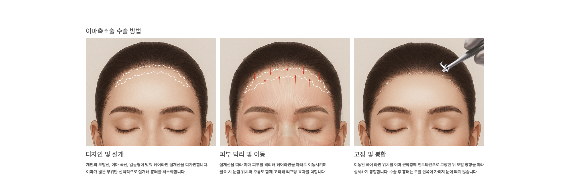 
        이마축소술 수술 방법
        디자인 및 절개 : 개인의 모발선, 이마 곡선, 얼굴형에 맞춰 헤어라인 절개선을 디자인합니다. 이마가 넓은 부위만 선택적으로 절개해 흉터를 최소화합니다.
        피부 박리 및 이동 : 절개선을 따라 이마 피부를 박리해 헤어라인을 아래로 이동시키며 필요 시 눈썹 위치와 주름도 함께 고려해 리프팅 효과를 더합니다.
        고정 및 봉합 : 이동된 헤어 라인 위치를 이마 근막층에 엔토타인으로 고정한 뒤 모발 방향을 따라 섬세하게 봉합합니다. 수술 후 흉터는 모발 안쪽에 가려져 눈에 띄지 않습니다.
        