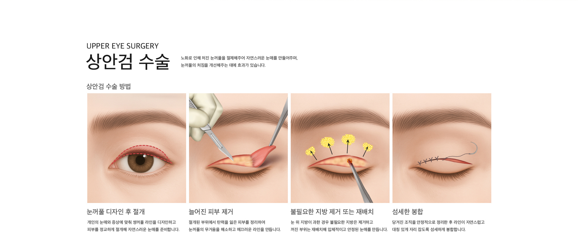 Upper Eye Surgery 상안검 수술 노화로 인해 처진 눈꺼풀을 절제해주어 자연스러운 눈매를 만들어주며, 눈꺼풀의 처짐을 개선해주는 데에 효과가 있습니다. 상안검 수술 방법 눈꺼풀 디자인 후 절개 : 개인의 눈매와 증상에 맞춰 쌍꺼풀 라인을 디자인하고 피부를 정교하게 절개해 자연스러운 눈매를 준비합니다. 늘어진 피부 제거 : 절개된 부위에서 탄력을 잃은 피부를 정리하여 눈꺼풀의 무거움을 해소하고 매끄러운 라인을 만듭니다. 불필요한 지방 제거 또는 재배치 : 눈 위 지방이 과한 경우 불필요한 지방은 제거하고 꺼진 부위는 재배치해 입체적이고 안정된 눈매를 만듭니다. 섬세한 봉합 : 당겨진 조직을 안정적으로 정리한 후 라인이 자연스럽고 대칭 있게 자리 잡도록 섬세하게 봉합합니다.