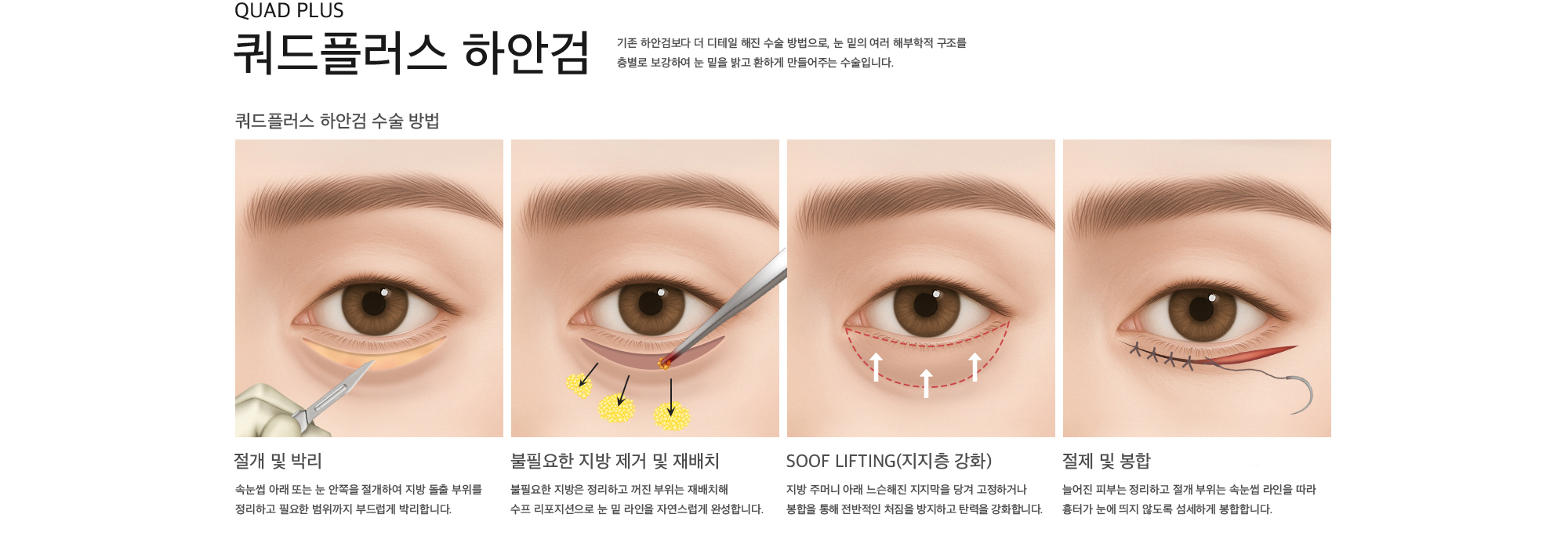 Quad Plus 쿼드플러스 하안검 기존 하안검보다 더 디테일 해진 수술 방법으로, 눈 밑의 여러 해부학적 구조를 층별로 보강하여 눈 밑을 밝고 환하게 만들어주는 수술입니다. 쿼드플러스 하안검 수술 방법 절개 및 박리 : 속눈썹 아래 또는 눈 안쪽을 절개하여 지방 돌출 부위를 정리하고 필요한 범위까지 부드럽게 박리합니다. 불필요한 지방 제거 및 재배치 : 불필요한 지방은 정리하고 꺼진 부위는 재배치해 수프 리포지션으로 눈 밑 라인을 자연스럽게 완성합니다. SOOF lifting(지지층 강화) : 지방 주머니 아래 느슨해진 지지막을 당겨 고정하거나 봉합을 통해 전반적인 처짐을 방지하고 탄력을 강화합니다. 절제 및 봉합 : 늘어진 피부는 정리하고 절개 부위는 속눈썹 라인을 따라 흉터가 눈에 띄지 않도록 섬세하게 봉합합니다.