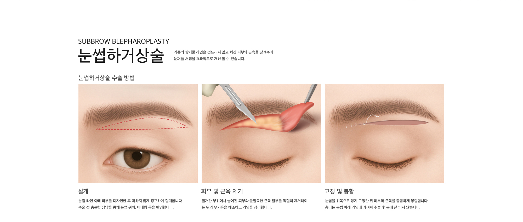 Subbrow Blepharoplasty 눈썹하거상술 기존의 쌍커풀 라인은 건드리지 않고 처진 피부와 근육을 당겨주어 눈꺼풀 처짐을 효과적으로 개선 할 수 있습니다.  눈썹하거상술 수술 방법 절개 : 눈썹 라인 아래 피부를 디자인한 후 과하지 않게 정교하게 절개합니다. 수술 전 충분한 상담을 통해 눈썹 위치, 비대칭 등을 반영합니다. 피부 및 근육 제거 : 절개한 부위에서 늘어진 피부와 불필요한 근육 일부를 적절히 제거하여 눈 위의 무거움을 해소하고 라인을 정리합니다. 고정 및 봉합 : 눈썹을 위쪽으로 당겨 고정한 뒤 피부와 근육을 꼼꼼하게 봉합합니다. 흉터는 눈썹 아래 라인에 가려져 수술 후 눈에 잘 띄지 않습니다.