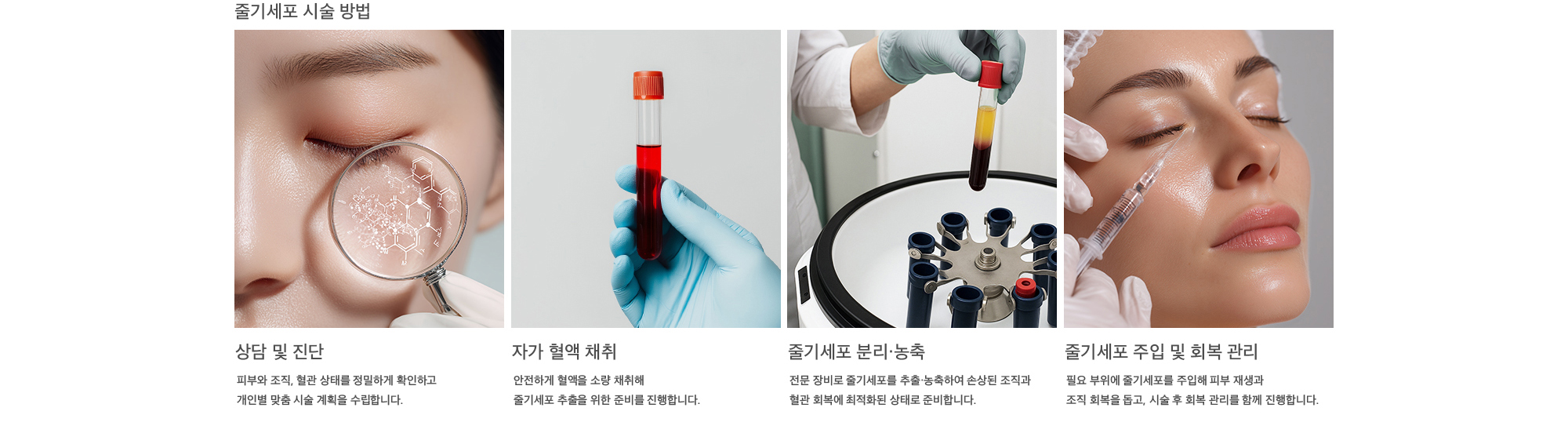 줄기세포 시술 방법 상담 및 진단 : 피부와 조직, 혈관 상태를 정밀하게 확인하고 개인별 맞춤 시술 계획을 수립합니다. 자가 혈액 채취 : 안전하게 혈액을 소량 채취해 줄기세포 추출을 위한 준비를 진행합니다. 줄기세포 분리·농축 : 전문 장비로 줄기세포를 추출·농축하여 손상된 조직과 혈관 회복에 최적화된 상태로 준비합니다. 줄기세포 주입 및 회복 관리 : 필요 부위에 줄기세포를 주입해 피부 재생과 조직 회복을 돕고, 시술 후 회복 관리를 함께 진행합니다.