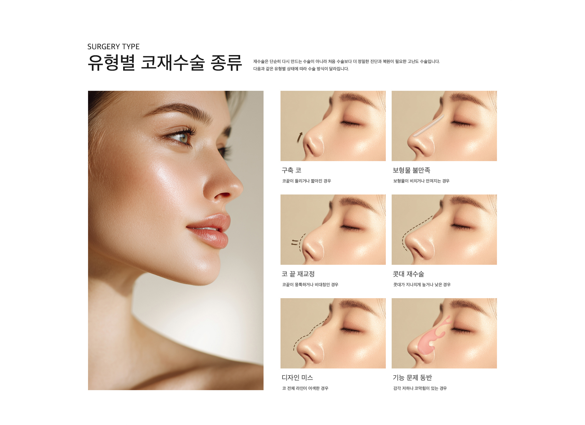 Surgery Type 유형별 코재수술 종류 재수술은 단순히 다시 만드는 수술이 아니라 처음 수술보다 더 정밀한 진단과 복원이 필요한 고난도 수술입니다. 다음과 같은 유형별 상태에 따라 수술 방식이 달라집니다. 구축 코 : 코끝이 들리거나 짧아진 경우,  코끝이 들리거나 짧아진 경우 : 보형물이 비치거나 만져지는 경우, 코 끝 재교정 : 코끝이 뭉툭하거나 비대칭인 경우, 콧대 재수술 : 콧대가 지나치게 높거나 낮은 경우, 디자인 미스 : 코 전체 라인이 어색한 경우, 기능 문제 동반 : 감각 저하나 코막힘이 있는 경우