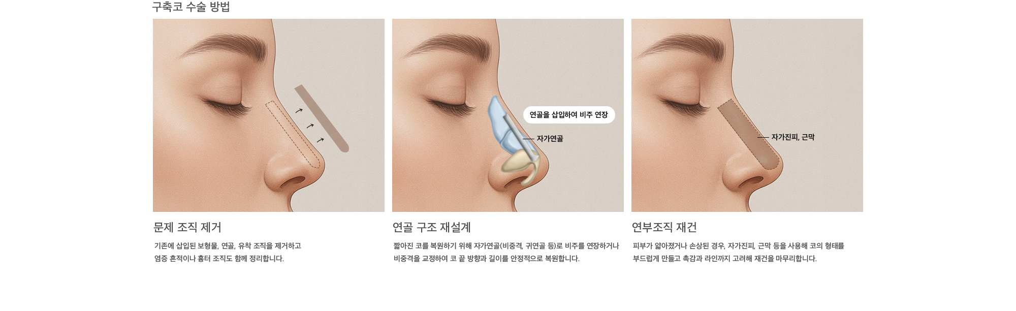 구축코 수술 방법 문제 조직 제거 : 기존에 삽입된 보형물, 연골, 유착 조직을 제거하고 염증 흔적이나 흉터 조직도 함께 정리합니다. 연골 구조 재설계 : 짧아진 코를 복원하기 위해 자가연골(비중격, 귀연골 등)로 비주를 연장하거나 비중격을 교정하여 코 끝 방향과 길이를 안정적으로 복원합니다.  연부조직 재건 : 피부가 얇아졌거나 손상된 경우, 자가진피, 근막 등을 사용해 코의 형태를 부드럽게 만들고 촉감과 라인까지 고려해 재건을 마무리합니다.