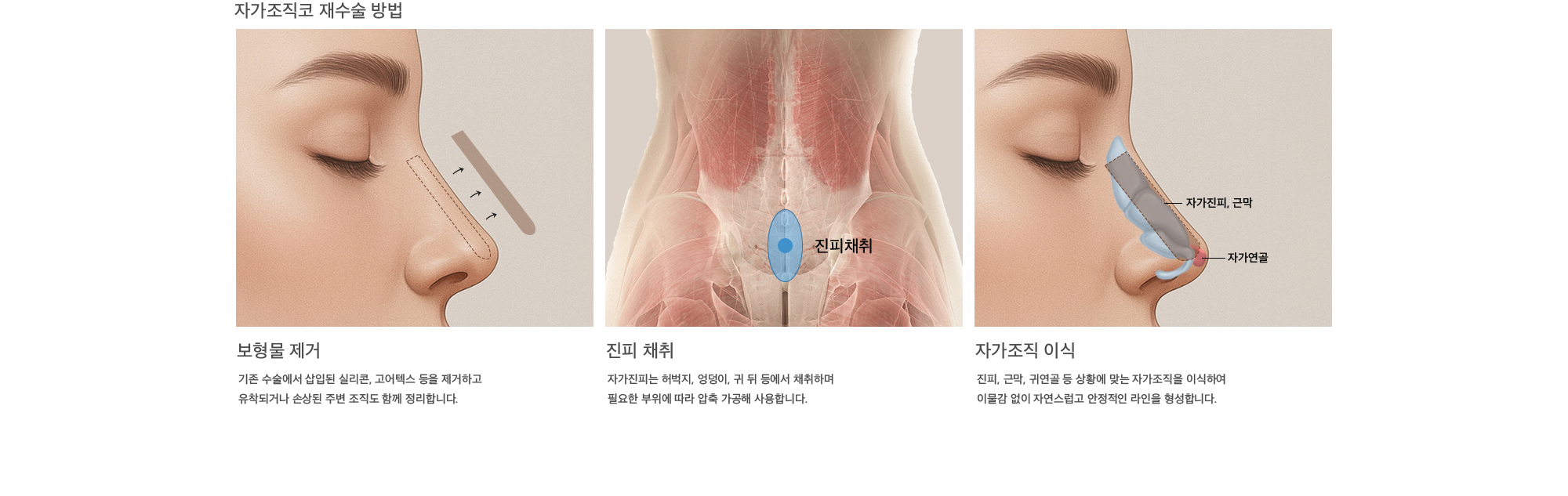자가조직코 재수술 방법 보형물 제거 : 기존 수술에서 삽입된 실리콘, 고어텍스 등을 제거하고 유착되거나 손상된 주변 조직도 함께 정리합니다. 진피 채취 : 자가진피는 허벅지, 엉덩이, 귀 뒤 등에서 채취하며 필요한 부위에 따라 압축 가공해 사용합니다. 자가조직 이식 : 진피, 근막, 귀연골 등 상황에 맞는 자가조직을 이식하여 이물감 없이 자연스럽고 안정적인 라인을 형성합니다.