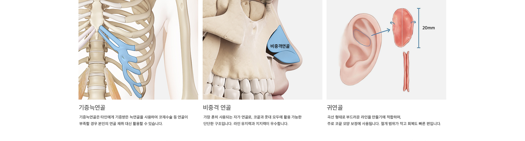 기증늑연골 : 기증늑연골은 타인에게 기증받은 늑연골을 사용하여 코재수술 등 연골이 부족할 경우 본인의 연골 채취 대신 활용할 수 있습니다. 비중격 연골 : 가장 흔히 사용되는 자가 연골로, 코끝과 콧대 모두에 활용 가능한 단단한 구조입니다. 라인 유지력과 지지력이 우수합니다. 귀연골 : 곡선 형태로 부드러운 라인을 만들기에 적합하며, 주로 코끝 모양 보정에 사용됩니다. 절개 범위가 작고 회복도 빠른 편입니다.