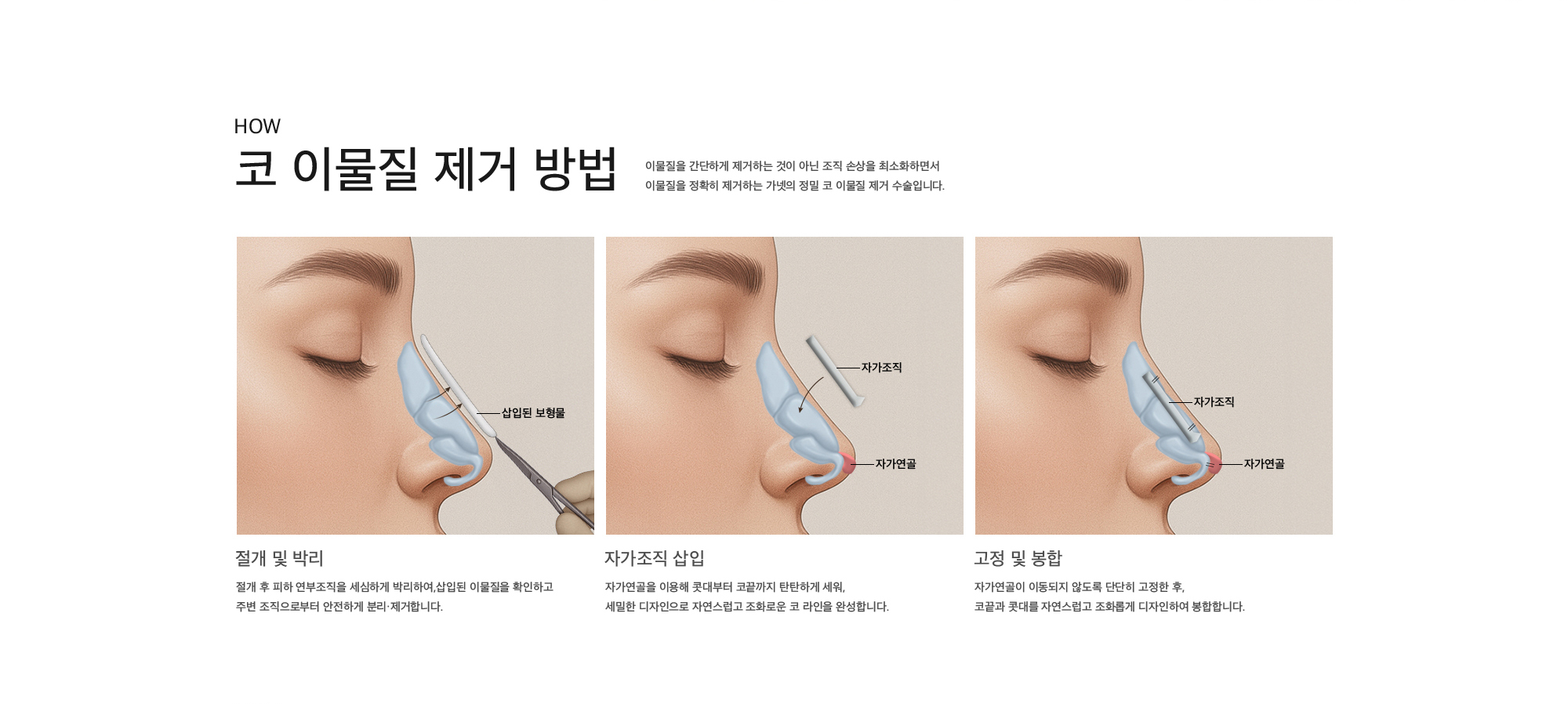 코 이물질 제거 방법 이물질을 간단하게 제거하는 것이 아닌 조직 손상을 최소화하면서 이물질을 정확히 제거하는 가넷의 정밀 코 이물질 제거 수술입니다. 절개 및 박리 : 절개 후 피하 연부조직을 세심하게 박리하여,삽입된 이물질을 확인하고 주변 조직으로부터 안전하게 분리·제거합니다.