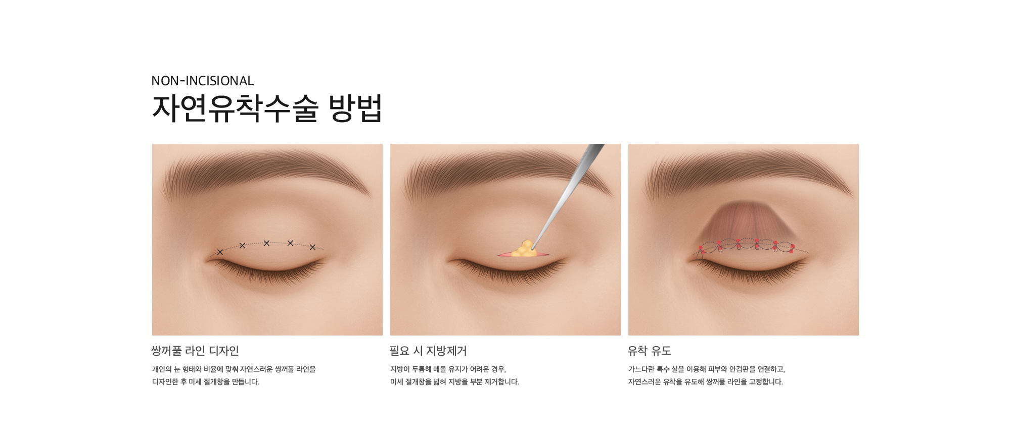 Non-Incisional 자연유착수술 방법 쌍꺼풀 라인 디자인 : 개인의 눈 형태와 비율에 맞춰 자연스러운 쌍꺼풀 라인을 디자인한 후 미세 절개창을 만듭니다. 필요 시 지방제거 : 지방이 두툼해 매몰 유지가 어려운 경우, 미세 절개창을 넓혀 지방을 부분 제거합니다. 유착 유도 : 가느다란 특수 실을 이용해 피부와 안검판을 연결하고, 자연스러운 유착을 유도해 쌍꺼풀 라인을 고정합니다.