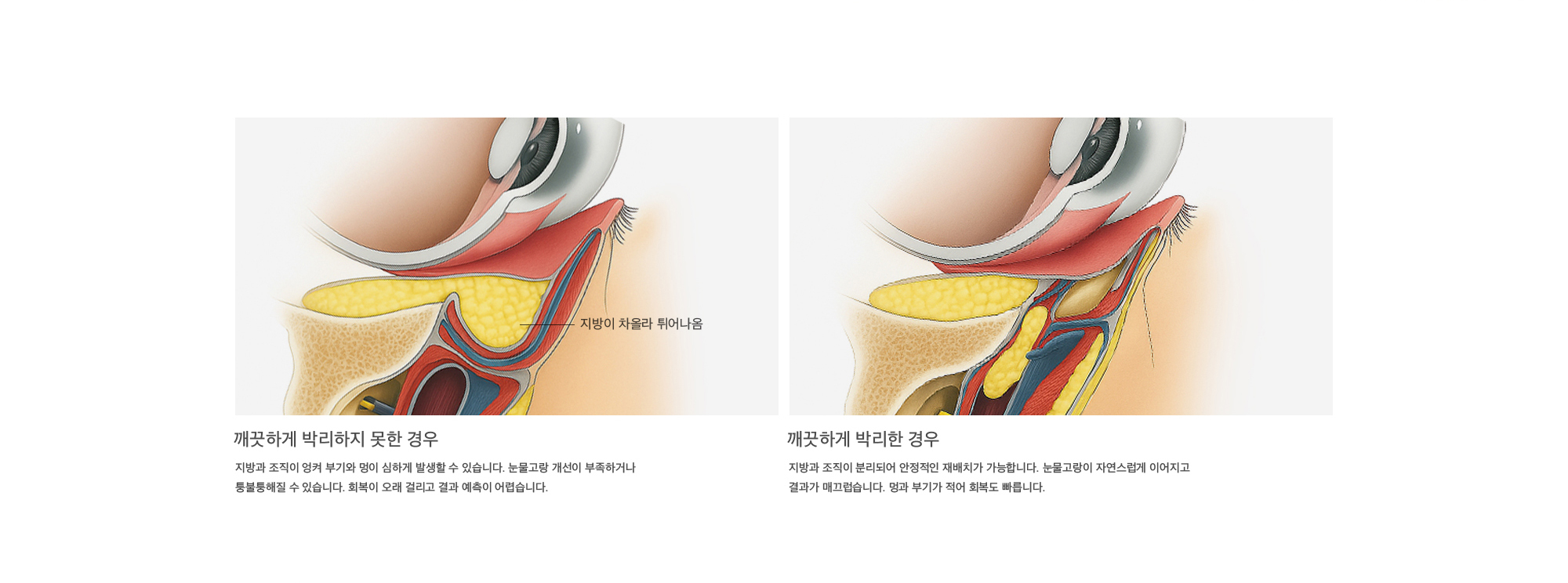 깨끗하게 박리하지 못한 경우 : 지방과 조직이 엉켜 부기와 멍이 심하게 발생할 수 있습니다. 눈물고랑 개선이 부족하거나 울퉁불퉁해질 수 있습니다. 회복이 오래 걸리고 결과 예측이 어렵습니다. 깨끗하게 박리한 경우 : 지방과 조직이 분리되어 안정적인 재배치가 가능합니다. 눈물고랑이 자연스럽게 이어지고 결과가 매끄럽습니다. 멍과 부기가 적어 회복도 빠릅니다.