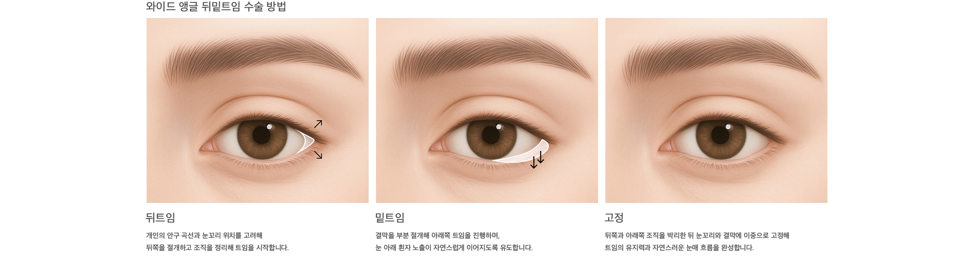 와이드 앵글 뒤밑트임 수술 방법 뒤트임 : 개인의 안구 곡선과 눈꼬리 위치를 고려해 뒤쪽을 절개하고 조직을 정리해 트임을 시작합니다. 밑트임 : 결막을 부분 절개해 아래쪽 트임을 진행하며, 눈 아래 흰자 노출이 자연스럽게 이어지도록 유도합니다. 고정 : 뒤쪽과 아래쪽 조직을 박리한 뒤 눈꼬리와 결막에 이중으로 고정해 트임의 유지력과 자연스러운 눈매 흐름을 완성합니다.