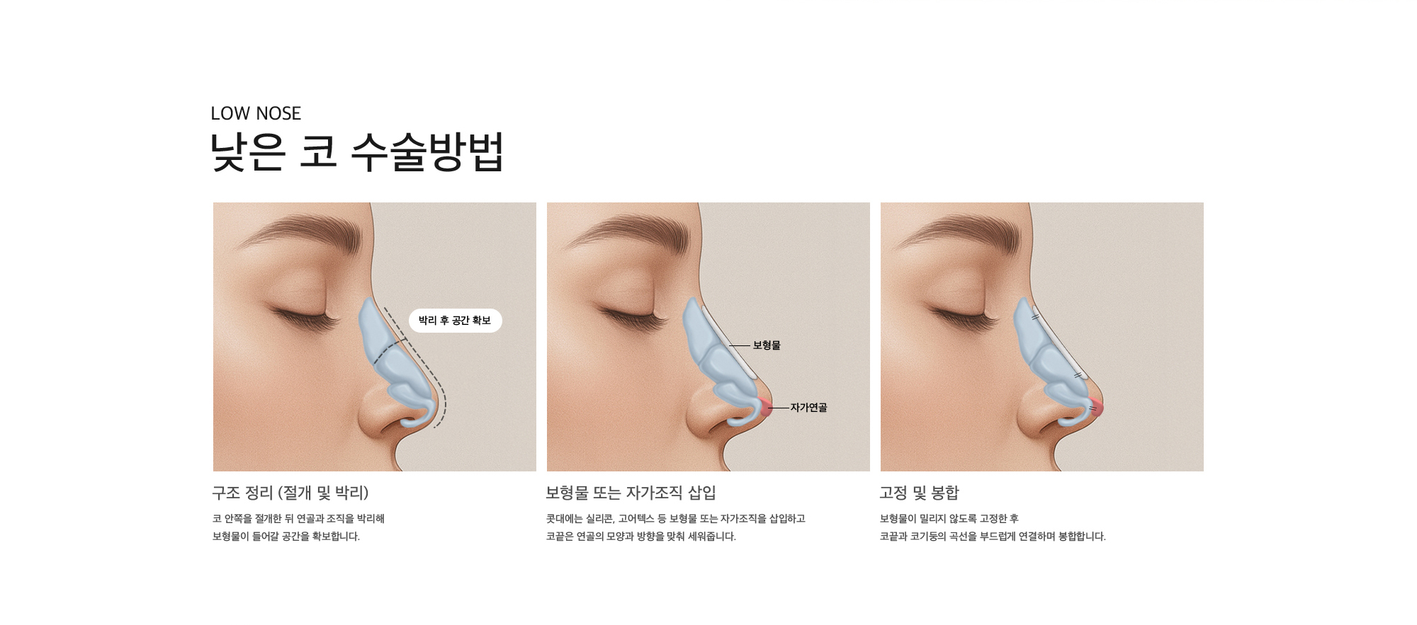 낮은 코 수술방법 구조 정리 (절개 및 박리) : 코 안쪽을 절개한 뒤 연골과 조직을 박리해 보형물이 들어갈 공간을 확보합니다. 보형물 또는 자가조직 삽입 : 콧대에는 실리콘, 고어텍스 등 보형물 또는 자가조직을 삽입하고 코끝은 연골의 모양과 방향을 맞춰 세워줍니다. 고정 및 봉합 : 보형물이 밀리지 않도록 고정한 후 코끝과 코기둥의 곡선을 부드럽게 연결하며 봉합합니다.