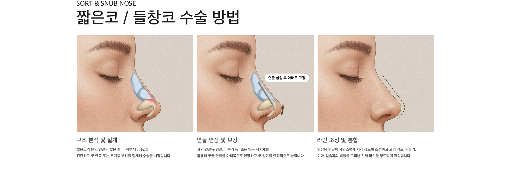 Sort & Snub nose 짧은코 / 들창코 수술 방법 구조 분석 및 절개 : 짧은코의 원인(연골의 짧은 길이, 피부 당김 등)을 진단하고 코 안쪽 또는 코기둥 부위를 절개해 수술을 시작합니다. 연골 연장 및 보강 : 자가 연골(귀연골, 비중격 등) 또는 인공 지지체를  활용해 코끝 연골을 아래쪽으로 연장하고 코 길이를 안정적으로 늘립니다. 라인 조정 및 봉합 : 연장된 연골이 자연스럽게 자리 잡도록 조정하고 코의 각도, 기울기, 이마–입술과의 비율을 고려해 전체 라인을 부드럽게 완성합니다.
