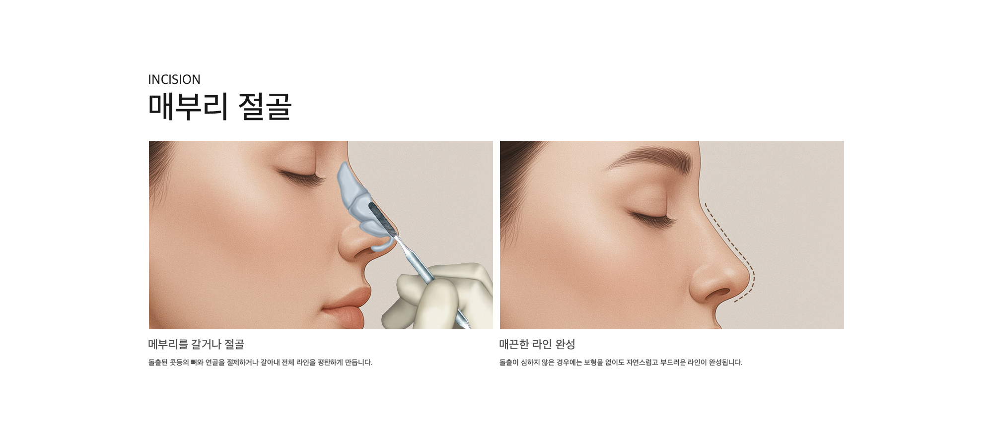 Incision 매부리 절골 메부리를 갈거나 절골 : 돌출된 콧등의 뼈와 연골을 절제하거나 갈아내 전체 라인을 평탄하게 만듭니다. 매끈한 라인 완성 : 돌출이 심하지 않은 경우에는 보형물 없이도 자연스럽고 부드러운 라인이 완성됩니다.