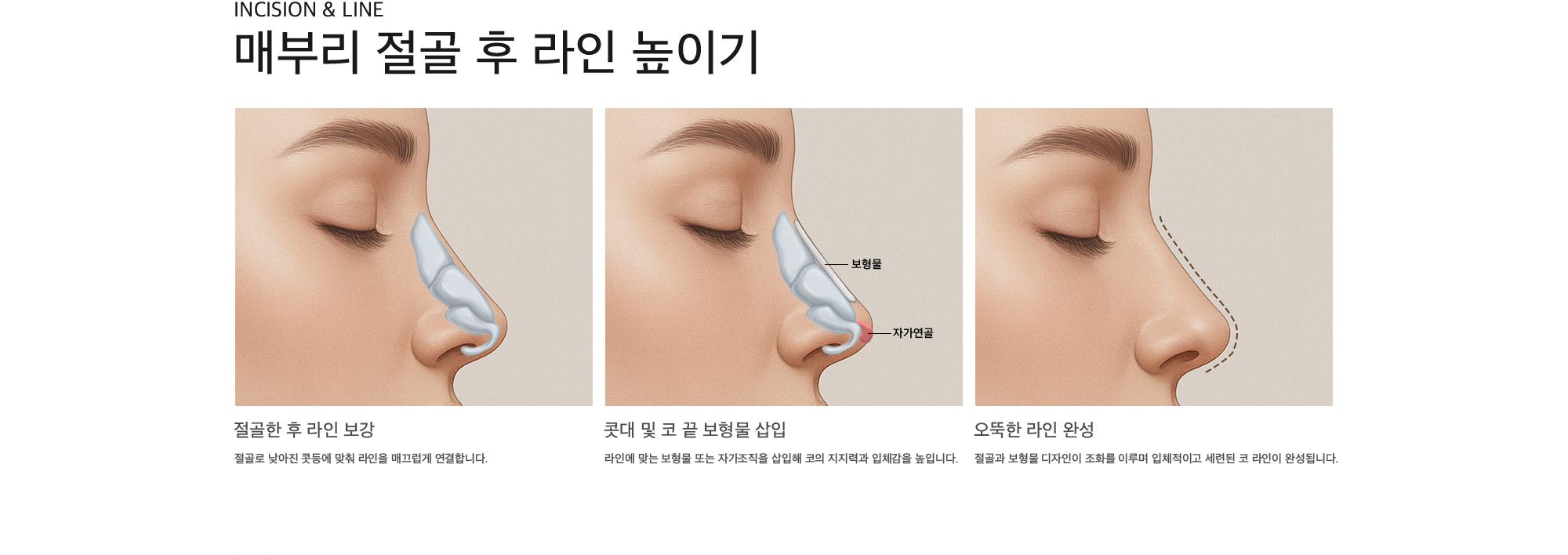 Incision & Line 매부리 절골 후 라인 높이기 절골한 후 라인 보강 : 절골로 낮아진 콧등에 맞춰 라인을 매끄럽게 연결합니다. 콧대 및 코 끝 보형물 삽입 : 라인에 맞는 보형물 또는 자가조직을 삽입해 코의 지지력과 입체감을 높입니다. 오뚝한 라인 완성 : 절골과 보형물 디자인이 조화를 이루며 입체적이고 세련된 코 라인이 완성됩니다.