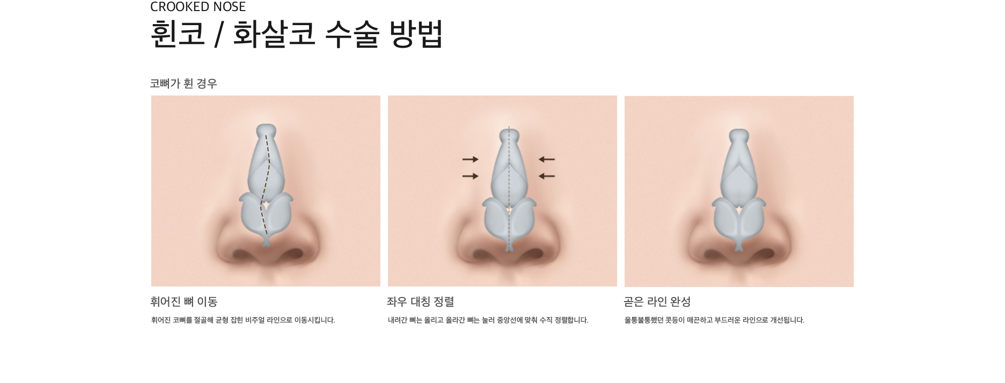 Crooked nose 휜코 / 화살코 수술 방법 코뼈가 휜 경우 휘어진 뼈 이동 : 휘어진 코뼈를 절골해 균형 잡힌 비주얼 라인으로 이동시킵니다.  좌우 대칭 정렬 : 내려간 뼈는 올리고 올라간 뼈는 눌러 중앙선에 맞춰 수직 정렬합니다. 곧은 라인 완성 : 울퉁불퉁했던 콧등이 매끈하고 부드러운 라인으로 개선됩니다.