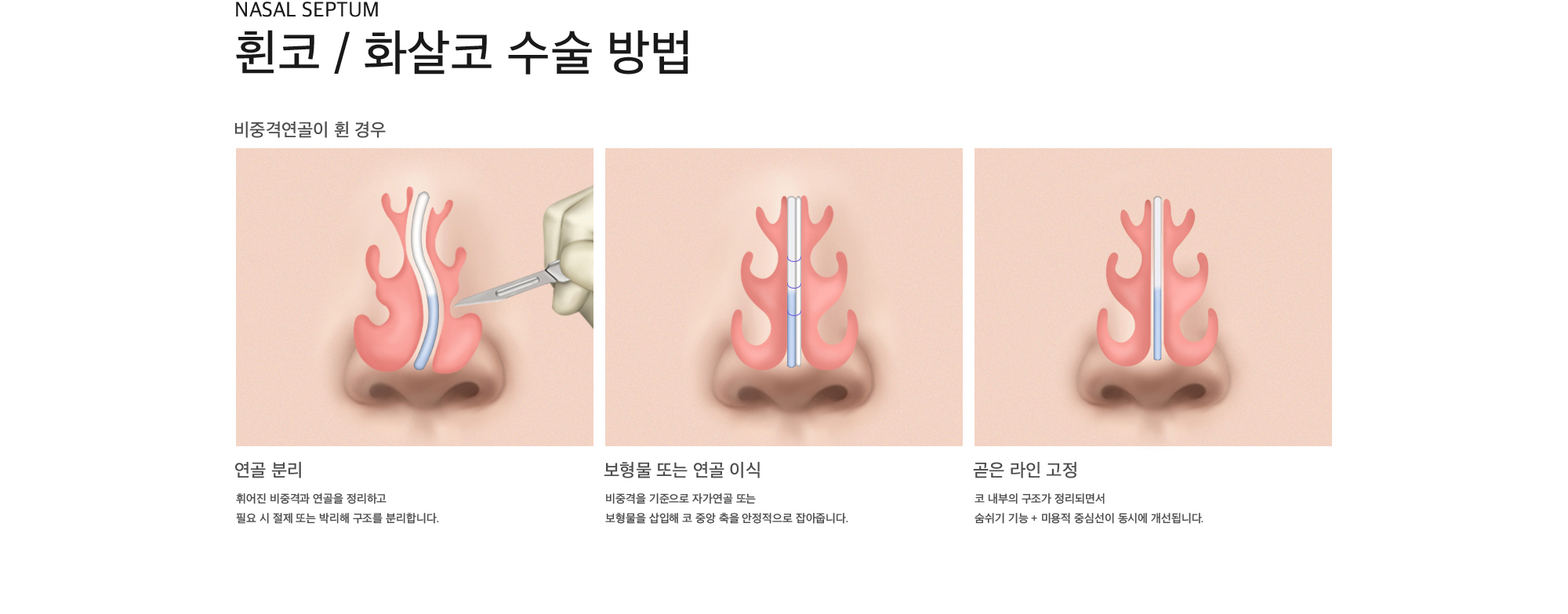 Nasal septum 휜코 / 화살코 수술 방법 비중격연골이 휜 경우 비중격연골이 휜 경우 : 휘어진 비중격과 연골을 정리하고 필요 시 절제 또는 박리해 구조를 분리합니다. 보형물 또는 연골 이식 : 비중격을 기준으로 자가연골 또는 보형물을 삽입해 코 중앙 축을 안정적으로 잡아줍니다. 곧은 라인 고정 : 코 내부의 구조가 정리되면서  숨쉬기 기능 + 미용적 중심선이 동시에 개선됩니다.
